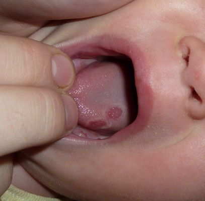 Симптомы появления язвы и вавок во рту