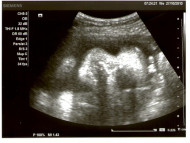 Фото УЗИ на 29 неделе беременности